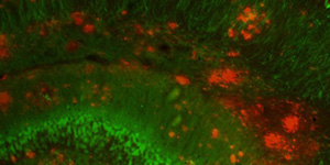 Cancer-Alzheimer's Disease Inverse Correlation (CADIC): From Biological Mechanisms to Therapeutic Potential Workshop